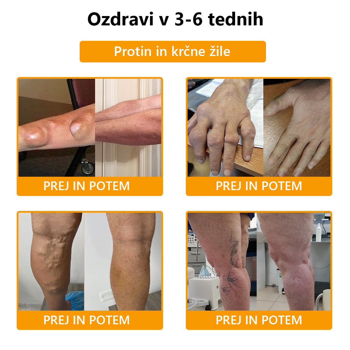 ArthroFree™ 🐝Zdravilna krema za artritis z čebeljim strupom in kurkumo - posebej oblikovana za zdravljenje ortopedskih bolezni in bolečin v sklepih 🍀