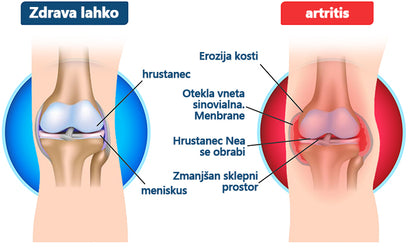 ArthroFree™ 🐝Zdravilna krema za artritis z čebeljim strupom in kurkumo - posebej oblikovana za zdravljenje ortopedskih bolezni in bolečin v sklepih 🍀