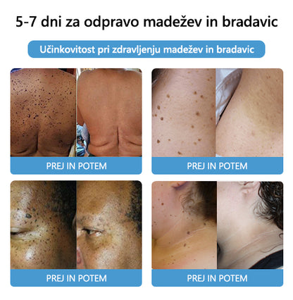 🐝🐝[🌟Uradna trgovina]🌟] Lenaro™ Krema za zdravljenje krtov in bradavic s čebeljim strupom (👨‍⚕AAD PRIPOROČA)