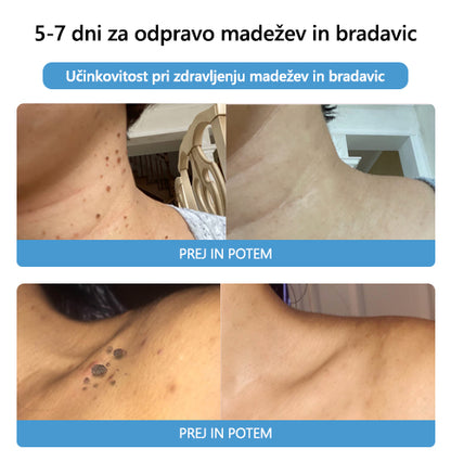 🐝🐝[🌟Uradna trgovina]🌟] Lenaro™ Krema za zdravljenje krtov in bradavic s čebeljim strupom (👨‍⚕AAD PRIPOROČA)