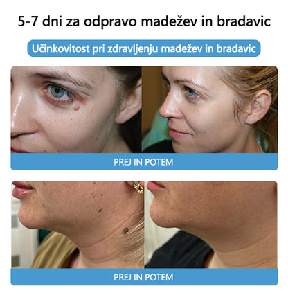 🐝🐝[🌟Uradna trgovina]🌟] Lenaro™ Krema za zdravljenje krtov in bradavic s čebeljim strupom (👨‍⚕AAD PRIPOROČA)