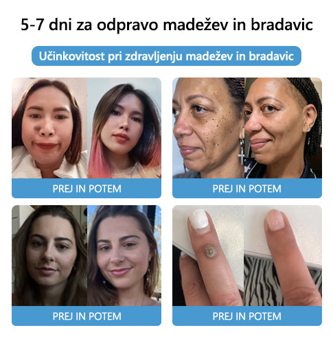 🐝🐝[🌟Uradna trgovina]🌟] Lenaro™ Krema za zdravljenje krtov in bradavic s čebeljim strupom (👨‍⚕AAD PRIPOROČA)